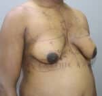 Gynecomastia (Puffy Nipples/ Male Chest Correction)