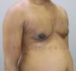 Gynecomastia (Puffy Nipples/ Male Chest Correction)