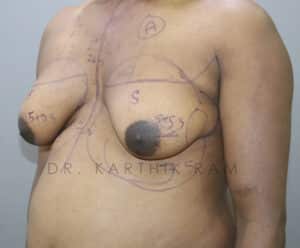 Gynecomastia (Puffy Nipples/ Male Chest Correction)