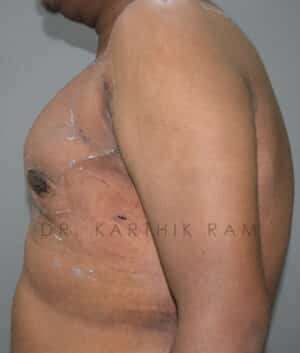 Gynecomastia (Puffy Nipples/ Male Chest Correction)