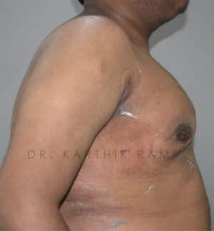 Gynecomastia (Puffy Nipples/ Male Chest Correction)
