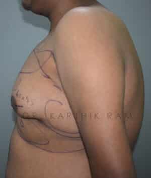 Gynecomastia (Puffy Nipples/ Male Chest Correction)