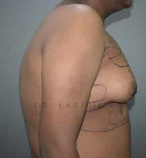 Gynecomastia (Puffy Nipples/ Male Chest Correction)