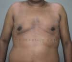 Gynecomastia (Puffy Nipples/ Male Chest Correction)