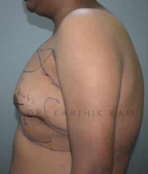 Gynecomastia (Puffy Nipples/ Male Chest Correction)