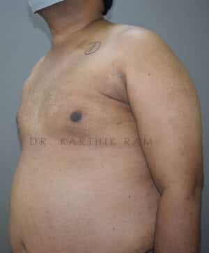Gynecomastia (Puffy Nipples/ Male Chest Correction)