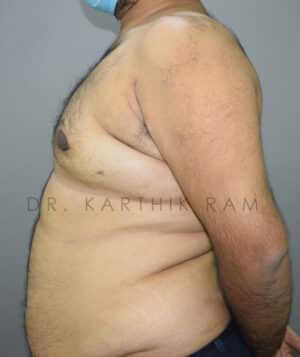 Gynecomastia (Puffy Nipples/ Male Chest Correction)