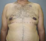 Gynecomastia (Puffy Nipples/ Male Chest Correction)