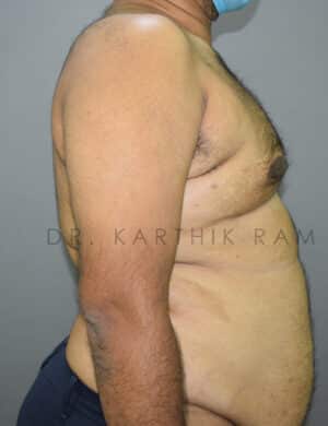 Gynecomastia (Puffy Nipples/ Male Chest Correction)