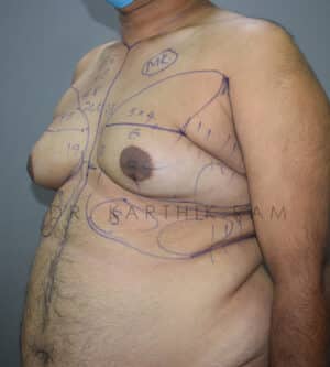 Gynecomastia (Puffy Nipples/ Male Chest Correction)