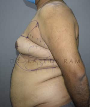 Gynecomastia (Puffy Nipples/ Male Chest Correction)