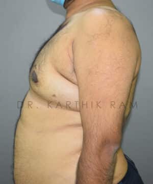 Gynecomastia (Puffy Nipples/ Male Chest Correction)
