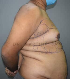 Gynecomastia (Puffy Nipples/ Male Chest Correction)