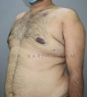 Gynecomastia (Puffy Nipples/ Male Chest Correction)