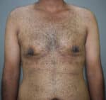 Gynecomastia (Puffy Nipples/ Male Chest Correction)