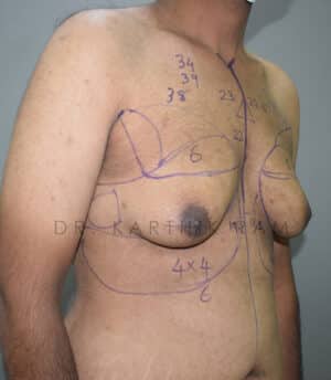 Gynecomastia (Puffy Nipples/ Male Chest Correction)
