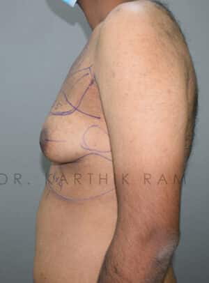 Gynecomastia (Puffy Nipples/ Male Chest Correction)