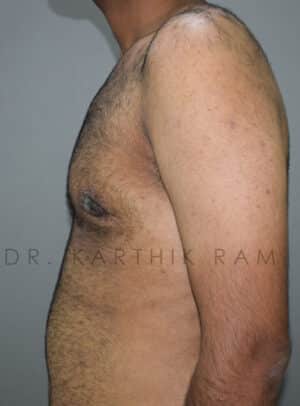 Gynecomastia (Puffy Nipples/ Male Chest Correction)