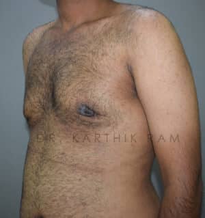 Gynecomastia (Puffy Nipples/ Male Chest Correction)