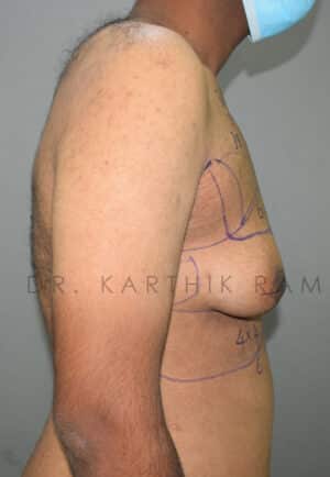 Gynecomastia (Puffy Nipples/ Male Chest Correction)