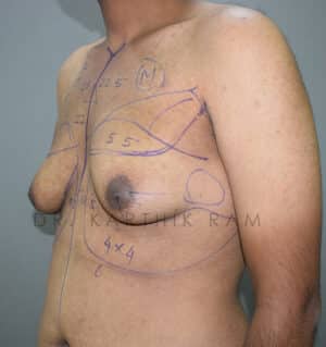 Gynecomastia (Puffy Nipples/ Male Chest Correction)