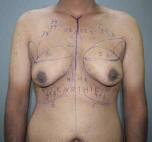 Gynecomastia (Puffy Nipples/ Male Chest Correction)