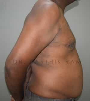 Gynecomastia (Puffy Nipples/ Male Chest Correction)