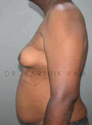 Gynecomastia (Puffy Nipples/ Male Chest Correction)