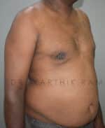 Gynecomastia (Puffy Nipples/ Male Chest Correction)