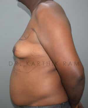 Gynecomastia (Puffy Nipples/ Male Chest Correction)