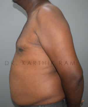 Gynecomastia (Puffy Nipples/ Male Chest Correction)