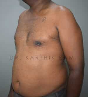 Gynecomastia (Puffy Nipples/ Male Chest Correction)