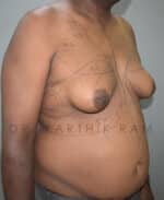 Gynecomastia (Puffy Nipples/ Male Chest Correction)