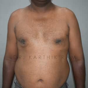 Gynecomastia (Puffy Nipples/ Male Chest Correction)
