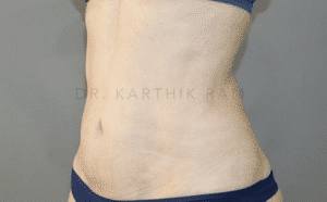 Liposuction Tummy and Back