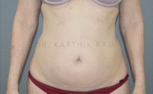 Liposuction Tummy and Back