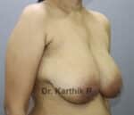 Breast Reduction and Breast Lift