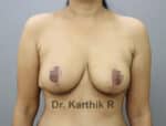 Breast Reduction and Breast Lift