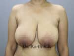 Breast Reduction and Breast Lift