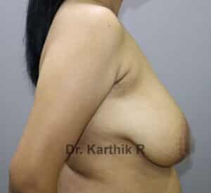 Breast Reduction and Breast Lift