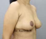 Breast Reduction and Breast Lift