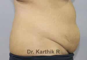 Tummy Tuck
