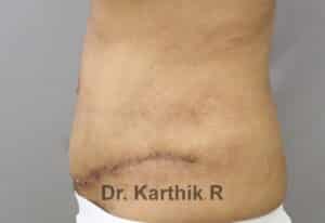 Tummy Tuck