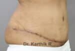 Tummy Tuck