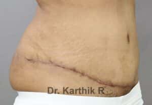 Tummy Tuck