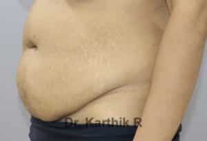 Tummy Tuck