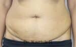 Tummy Tuck