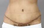 Tummy Tuck