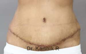 Tummy Tuck