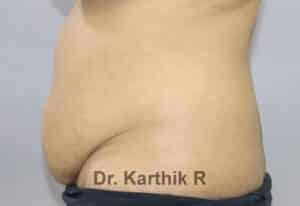 Tummy Tuck